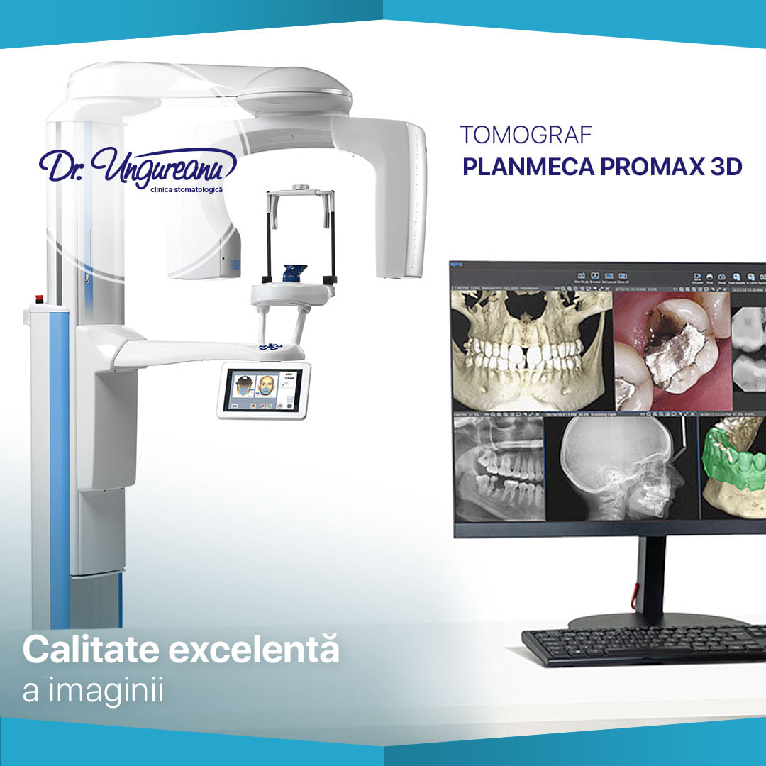 Tomografie Computerizată